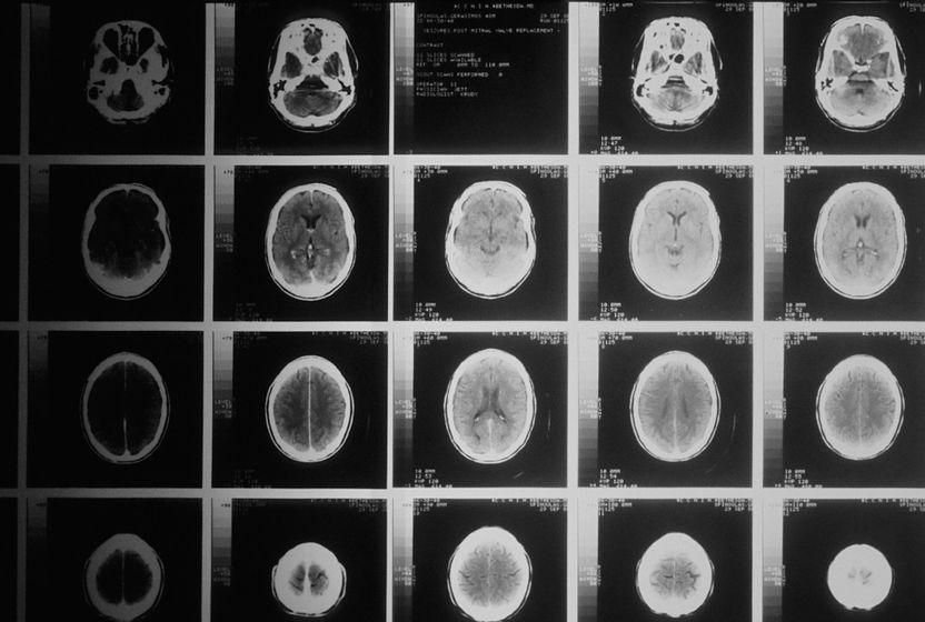 alzheimer-ilerlemesini-35-yavaslatan-yeni-bir-ilac-gelistirildi